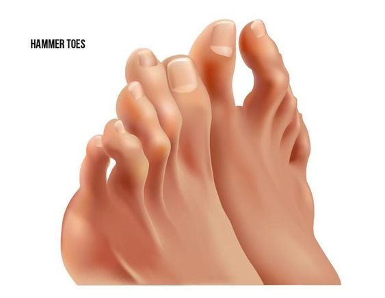 Hammertoes: Causes, Relief and Treatment